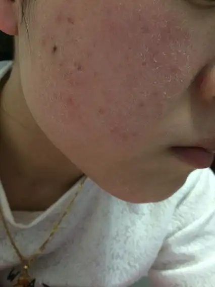 脸上皮肤又干,还脱皮,还有痘痘,之前还得过敏性皮炎,摸上去一点也不