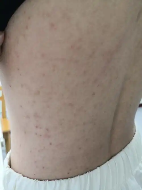 考虑马拉色菌毛囊炎症状可以使用药物抗真菌治疗#马拉色菌毛囊炎