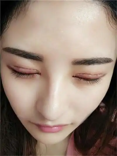 埋线双眼皮有哪些弊端