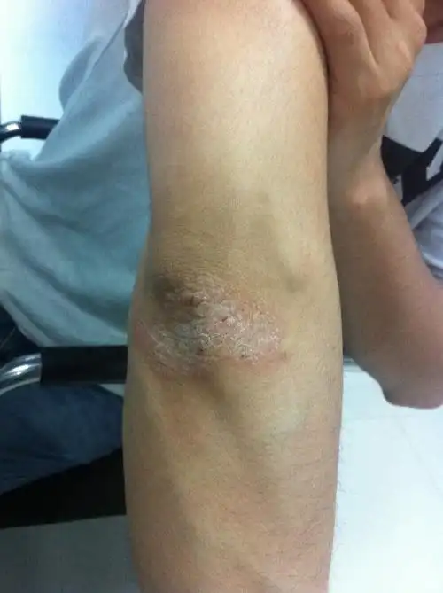 手肘起老茧(起壳),轻微痒,轻微疼痛(类似皮肤干裂或撕裂轻微疼痛