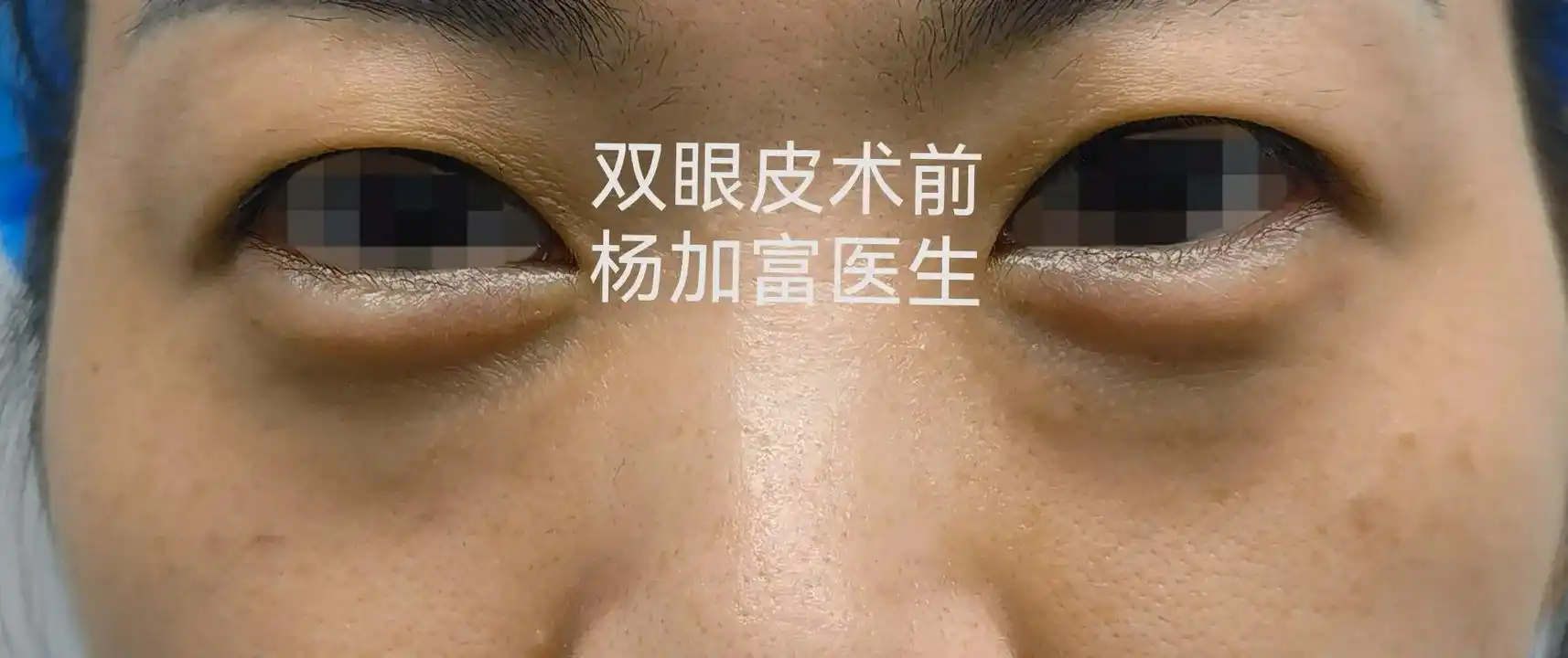 双眼皮手术的目的