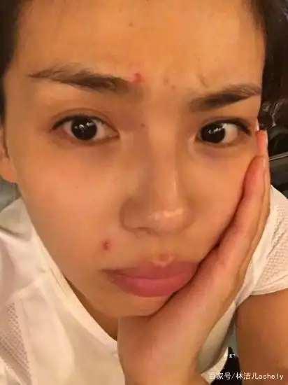 女明星长痘也喜欢晒?乔欣说自己是乞丐肌,刘涛痘痘遮都遮不住