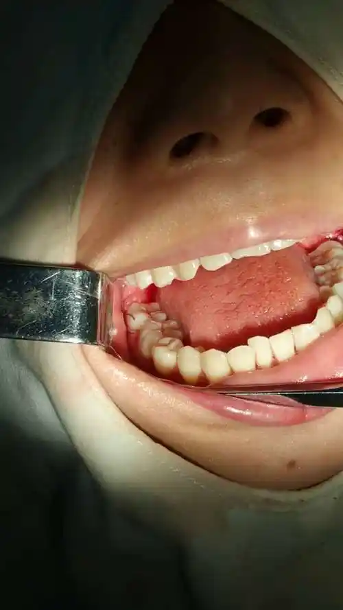 长智齿了怎么办?