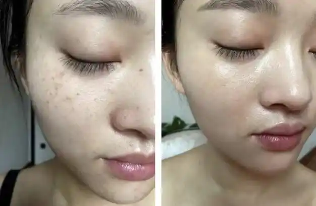 美白|祛斑|焕肤|淡斑|军训|军校|精华液|传明酸|战争法|敏感肌肤