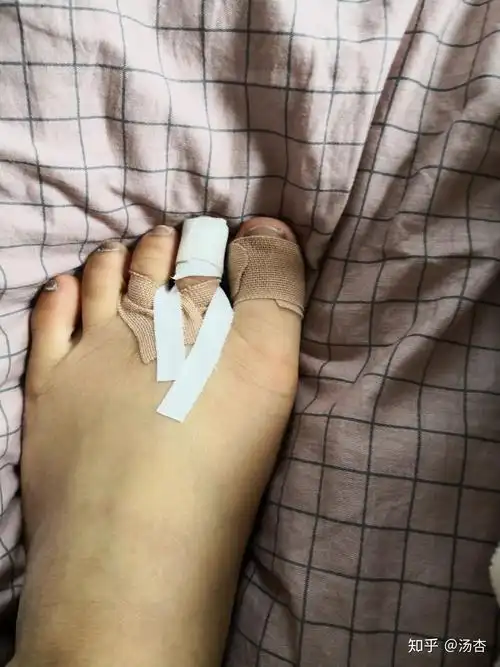 吃土少女的脚底保护的胶带的使用方法