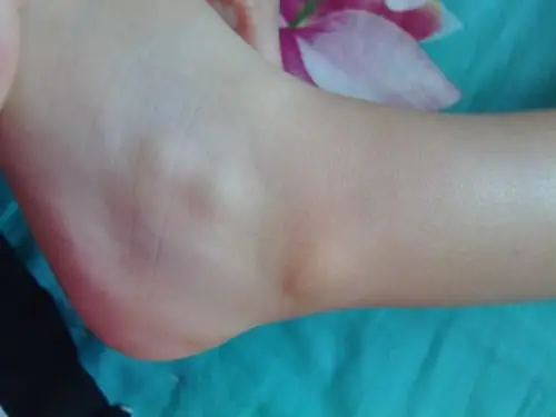 北京拇外翻医院_北京治疗拇外翻哪家医院好_北京治疗