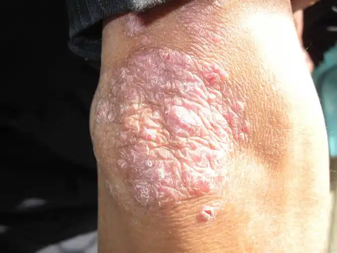 长春肤康医院浅谈:秋季预防牛皮癣复发,这几点需谨记_皮肤