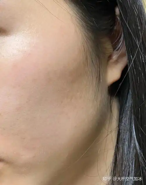 男孩子真的会在意女孩子皮肤不好嘛? - 知乎