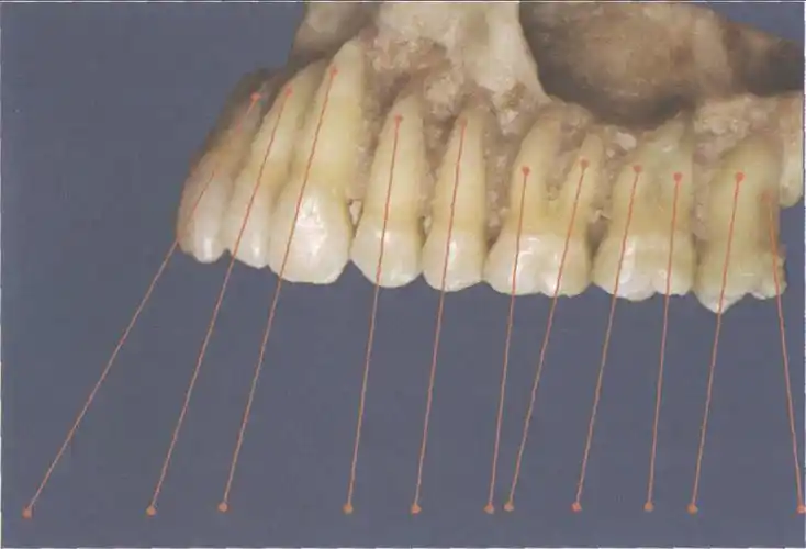 (图) 上颌牙体倾斜左侧观-口腔颌面及颈部临床解剖学-医学