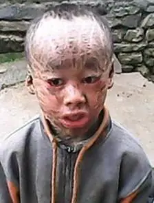 树皮娃娃引发网络关注,鱼鳞病症呼吁拒绝歧视