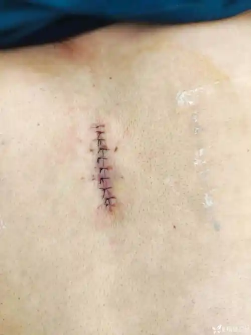 皮脂腺囊肿早期切开引流二期缝合经过