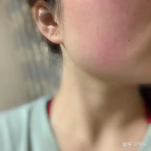 哪些护肤品容易过敏(哪些护肤成分容易过敏)