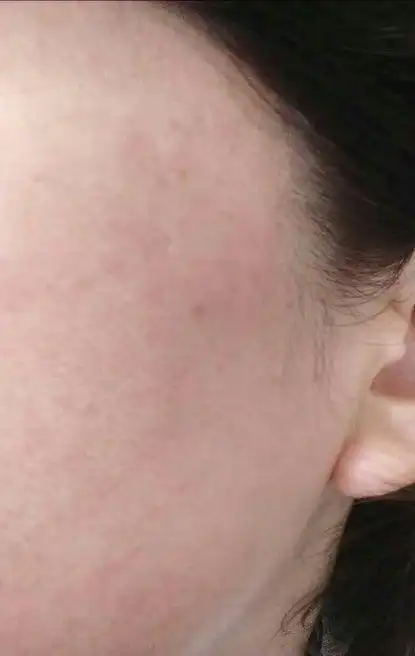 综上,无论是哪种敏感肌肤,都伴随皮肤屏障受损皮肤抵抗力情况.