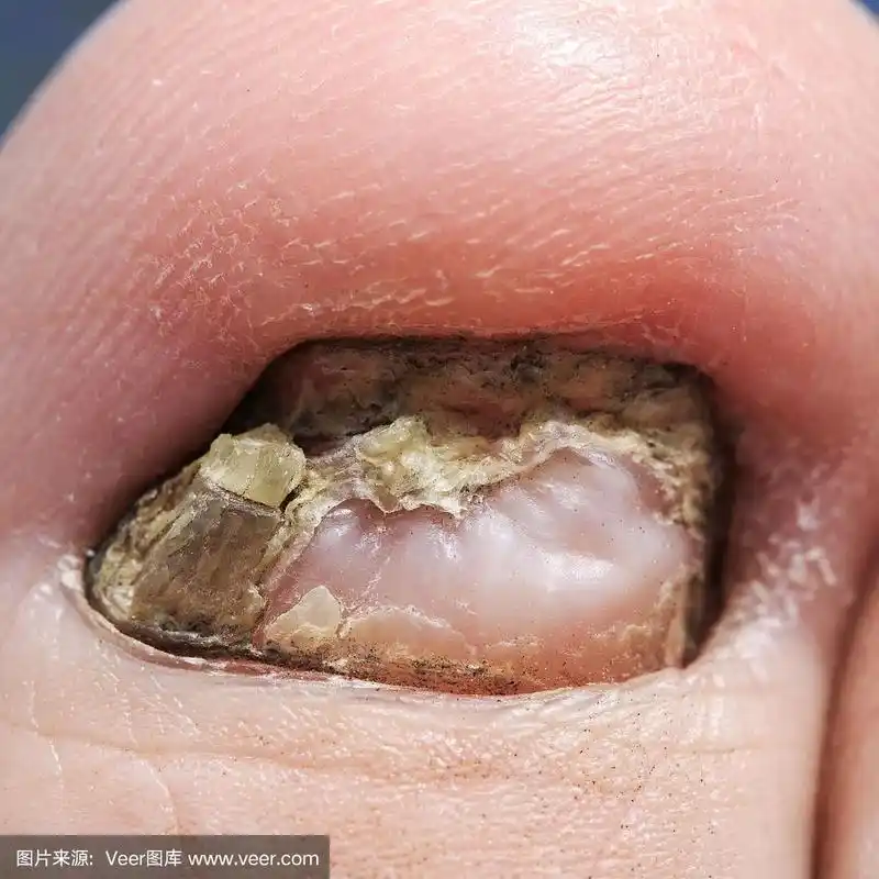 指甲被一个可怕的和讨厌的疾病真菌击中特写