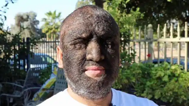 现实版"狼人",98%的身体覆盖着毛发,是世界上毛发最旺盛的人