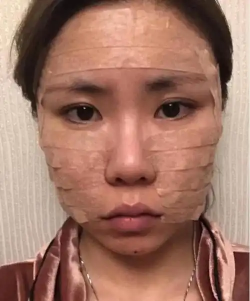 面部脂肪填充案例