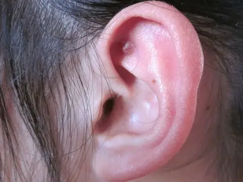 耳朵上突然长了一个正圆形的包,中间微凸,呈透明色,中间有白色物质.