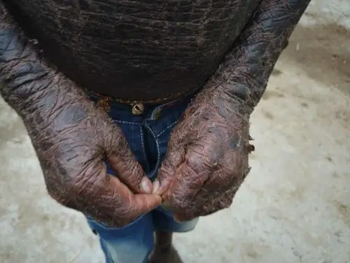 印度男孩患罕见遗传病全身布满鱼鳞被人称为人蛇