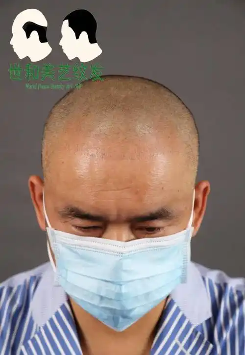 顶流华晨宇不缺头发,却植了发,有人却"小老头"变"气质大哥"_植发_对比