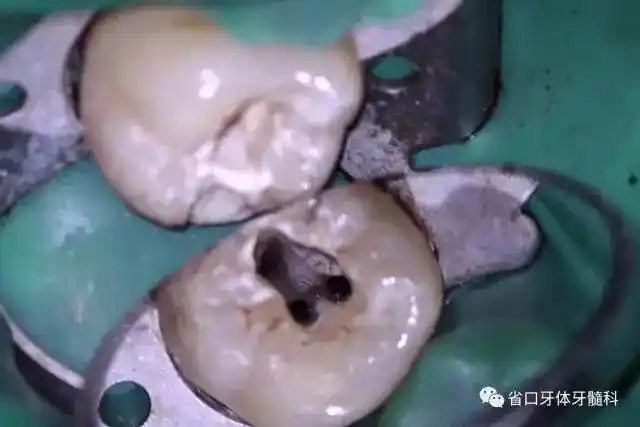 【病例分享】下颌第二磨牙根管治疗术后"印章法"树脂充填1例