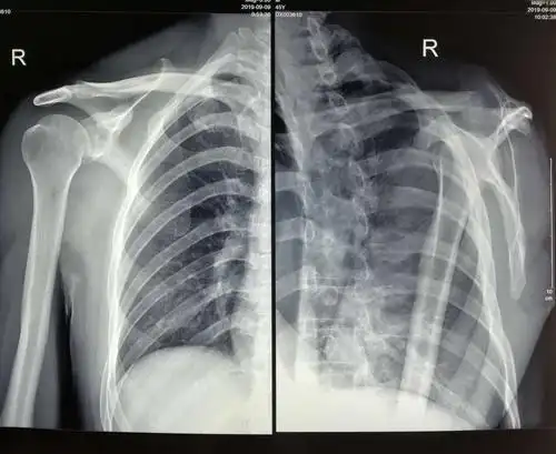 右肩冻结肩关节镜下松解诊治术