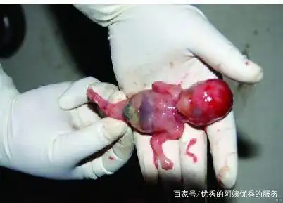 因为此时胎儿已经比较大了,不再适合选择早孕流产或者早孕药物流产