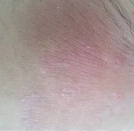 股癣的初期病情