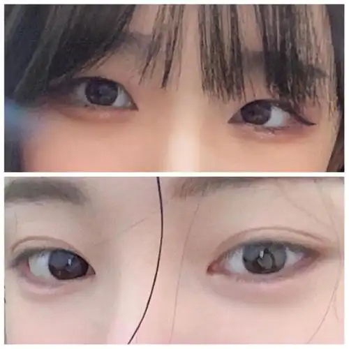 我做的是7.5毫米的平行双眼皮,杨蓉当时是给了我两_圈子-新氧美容整形