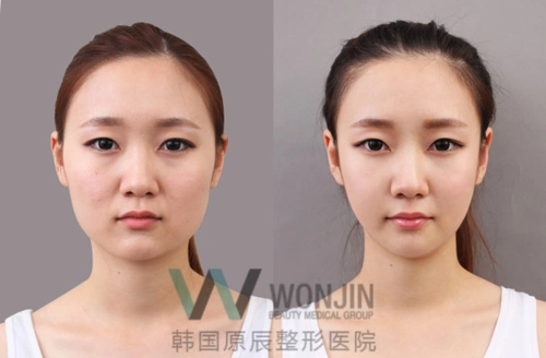 原辰整形医院下颌角手术前后对比