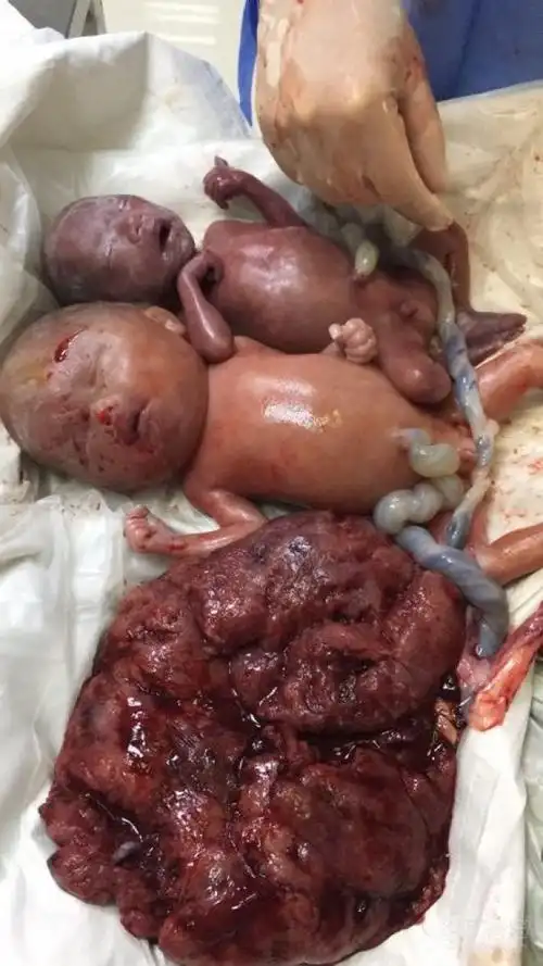 好典型的图!23周双胎引产 [病例帖]