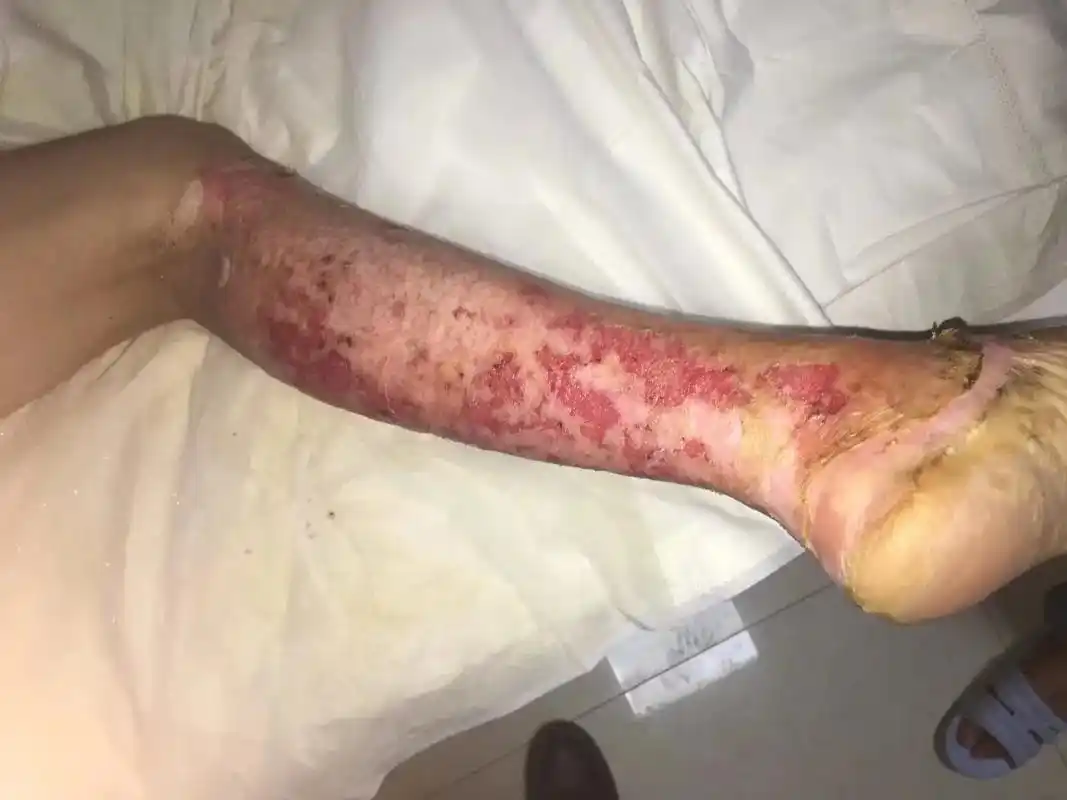 煤气爆燃深二度三度烧伤恢复前后对比照片图 - 抖音