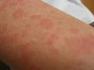 脂溢性皮炎怎么治较好