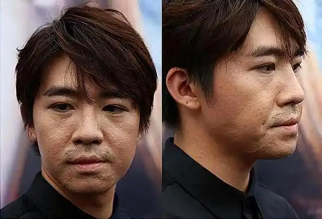 被烧伤毁容的俞灏明,曾与相恋多年女友提出分手,如今怎样了?