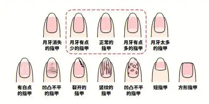 指甲被称作为"健康反馈小窗口",一旦形状与颜色有变化,"或多或少"代表