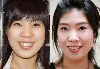 韩国明星牙齿矫正前后对比