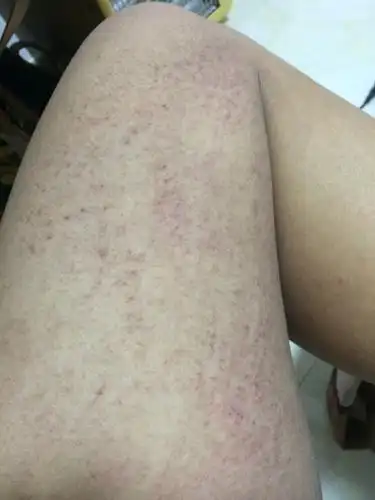 腿上皮肤冬天成这样了 怎么恢复?