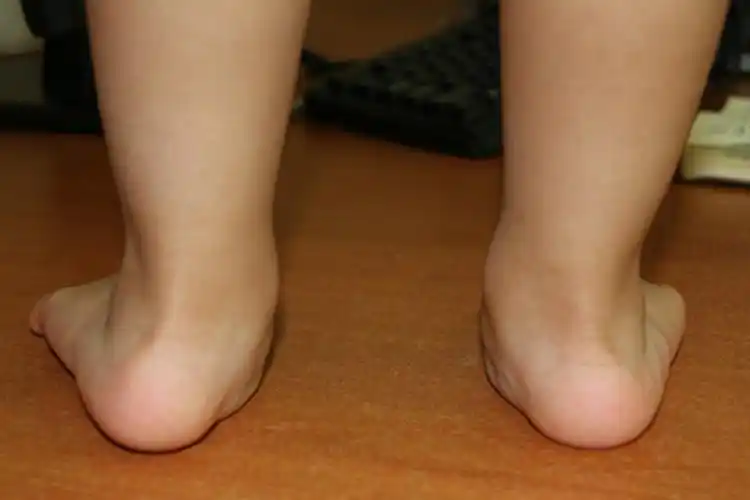 儿童小腿外翻图片