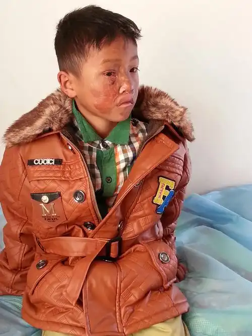 术后阿昌族烧伤小孩石明昌的右眼已能完全睁开