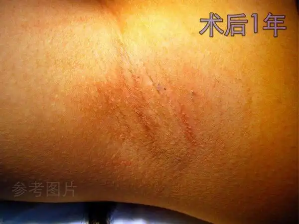 微创小切口皮下修剪术治疗腋臭