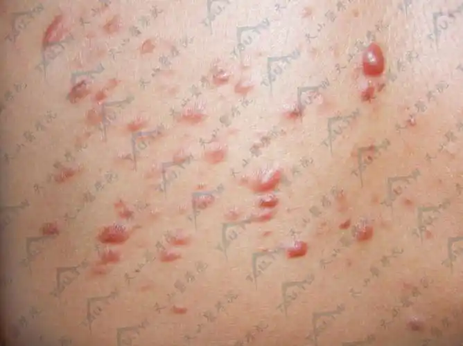 平滑肌瘤(leiomyoma)