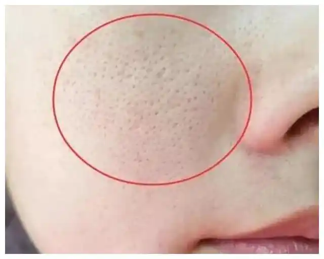 毛孔粗大如何改善,教你改善毛孔的方法