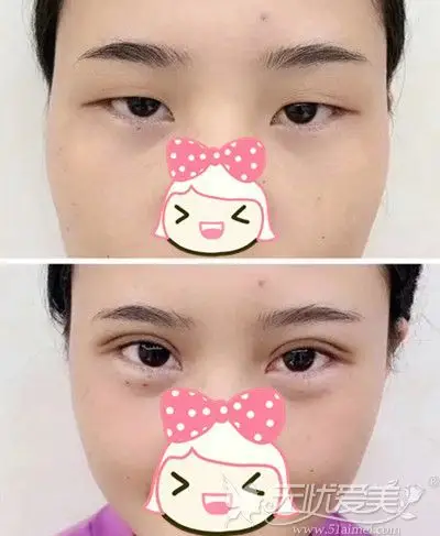 只做了个全切双眼上睑提肌就改善了我的肿眼泡和单眼皮