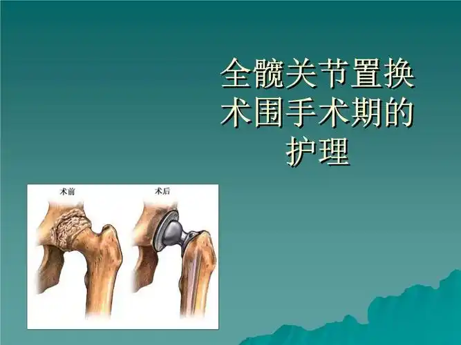 髋关节置换术围手术期护理(2).ppt