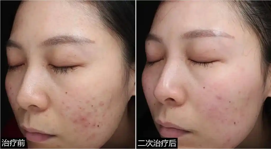 【祛痘科普】痘肌各种问题修复,有这些医美治疗方案推荐!