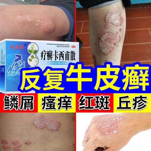 疗癣卡西甫散牛皮癣特专效用药牛皮癣 药膏 真菌止痒 抑菌 皮肤 3本品