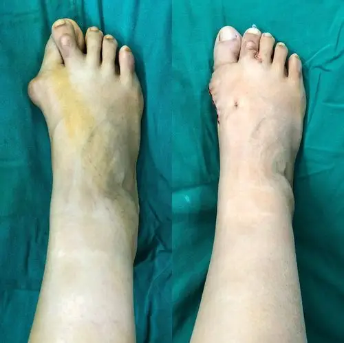 拇外翻交叉足趾矫形术 - 好大夫在线