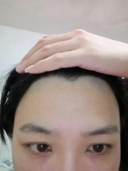 有没有因为额头低而脱发际线的? - 知乎