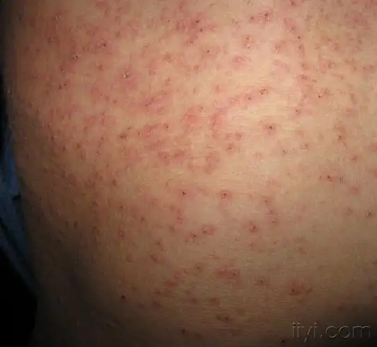 这是什么病疥疮吗