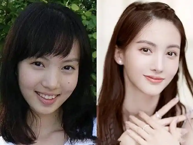 这些明星缩小完鼻翼,令人窒息过度缩小鼻翼,小心变成_圈子-新氧美容