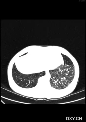 【影像读片】肺隔离症?